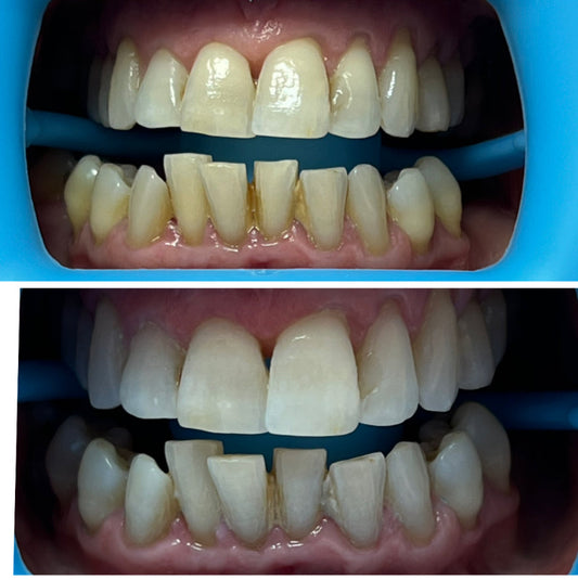 🦷 How Many Shades Whiter Can Teeth Whitening Make Your Smile?